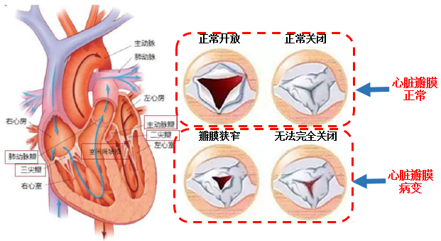 主动脉三个冠瓣示意图图片